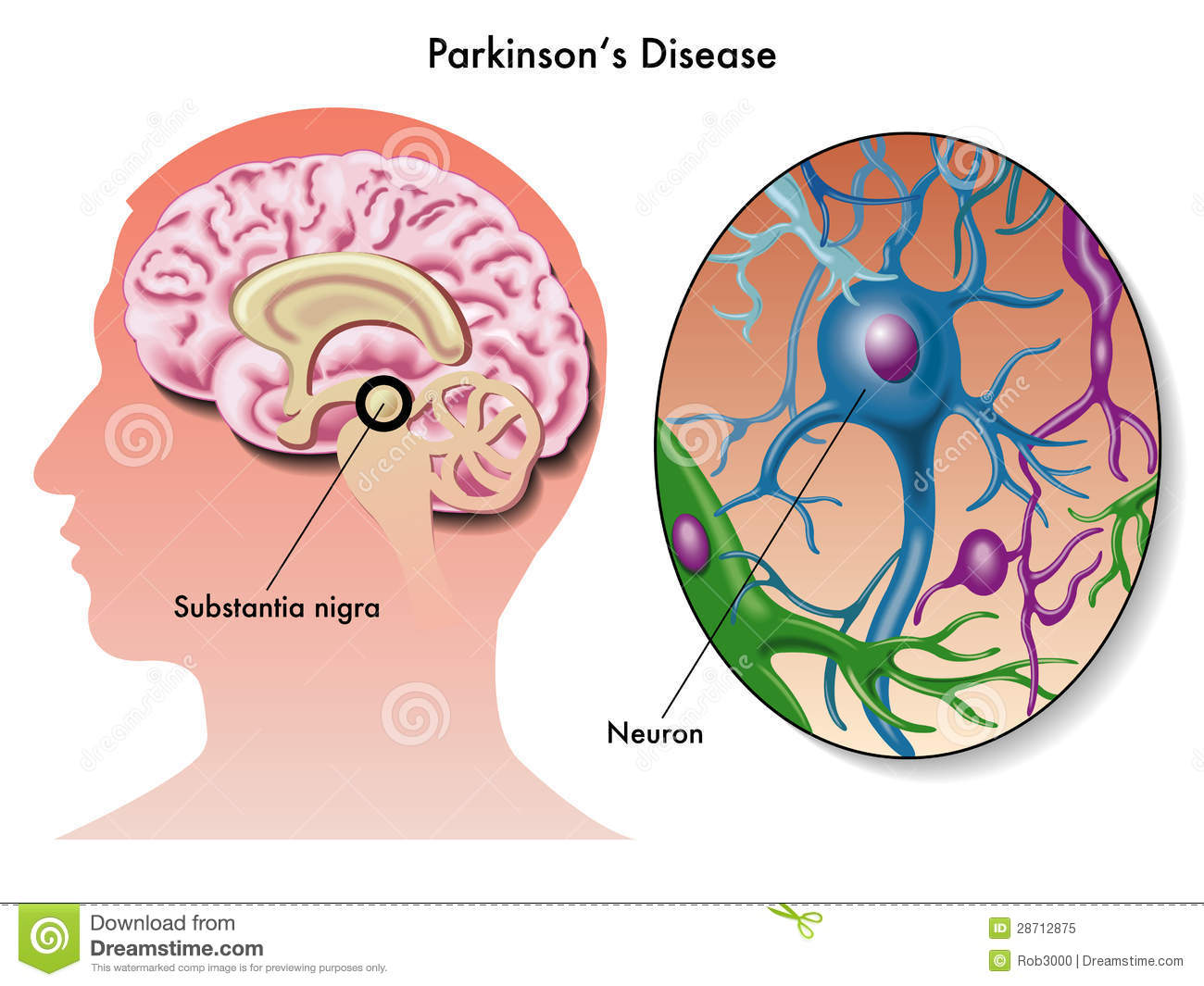 Doença de parkinson